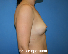 plastic-surgery-breast-augmentation